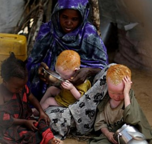 Албиносите в Африка - гонят ги и ги убиват като животни