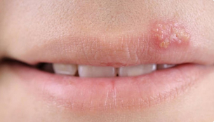 Херпесът не е просто леко кожно заболяване. Всъщност, той е по-опасен, отколкото си мислите!